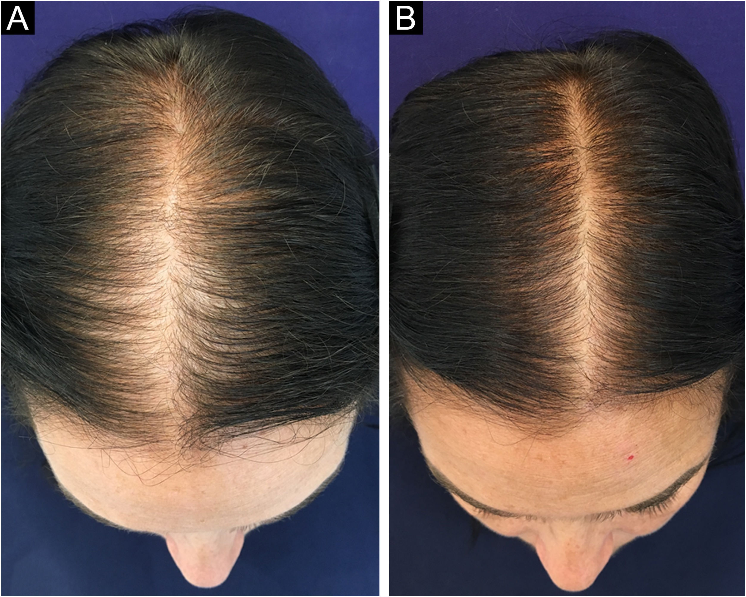 	Diga Adeus à Queda de Cabelo com Minoxidil - Imagem 2