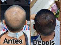 	Diga Adeus à Queda de Cabelo com Minoxidil - Imagem 3